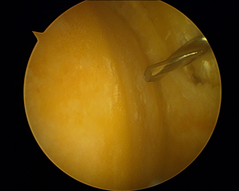 Microfractures des zones de défect chondral condyle et tibial interne
