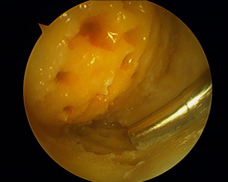 Lésions en miroir condyle et tibia interne, avec zone de disparition de cartilage de 6cm2 en condyle, et 2,5cm2 en tibial, puis greffe cellules souches